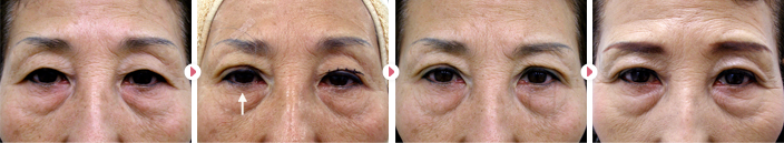 67歳(女性)切らない眼瞼下垂の症例写真