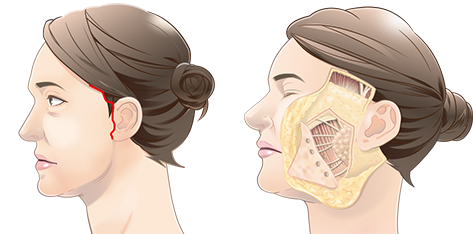 フェイスリフトの施術方法