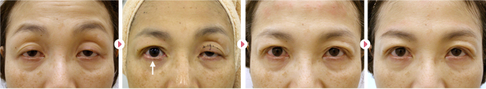 加齢＋ハードコンタクトの眼瞼下垂モニター患者さんの症例写真です。