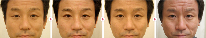 35歳(男性)先天性眼瞼下垂の症例写真