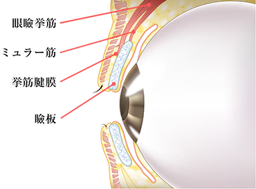 眼瞼下垂切開法