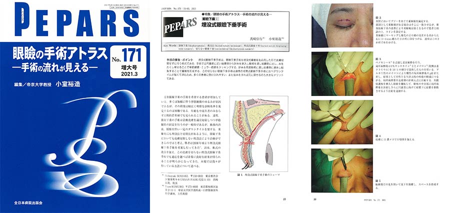 切らない眼瞼下垂の発案者、真崎の施術が受けられます