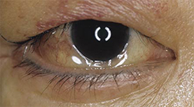 眼球結膜の浮腫