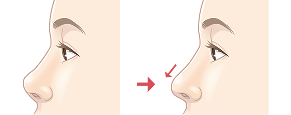 鼻中隔延長術のビフォーアフターイメージ