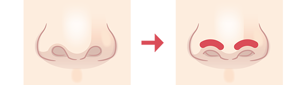 鼻孔縁下降術の施術方法