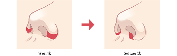 鼻翼縮小術の施術方法