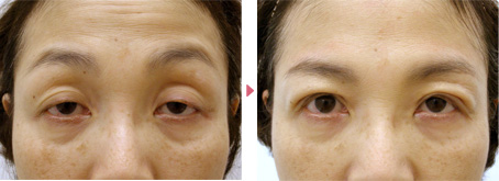 54歳(女性)重度のコンタクトレンズ性眼瞼下垂の症例写真