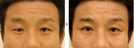 35歳(男性)先天性眼瞼下垂・右目の埋没式挙筋短縮術の症例写真