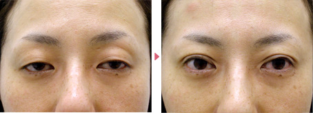 48歳(女性)ハードコンタクト性眼瞼下垂の症例写真