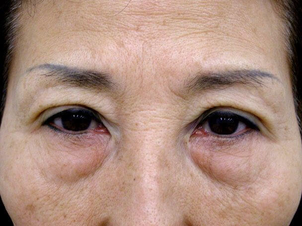 No.100 切らない眼瞼下垂(たるみ・くぼみ・たくし上げ) 術後30分の症例写真