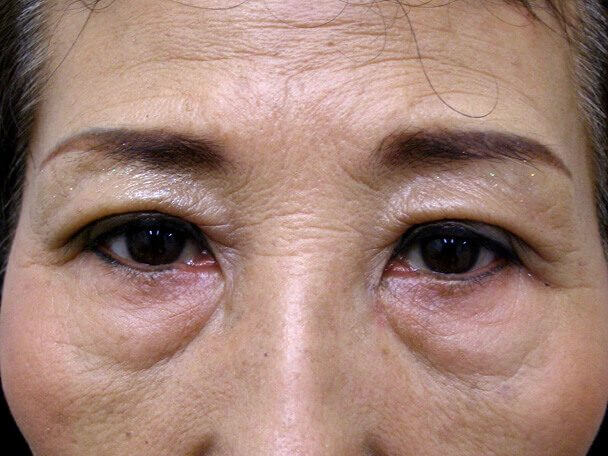 No.100 切らない眼瞼下垂(たるみ・くぼみ・たくし上げ) 術後1週間の症例写真