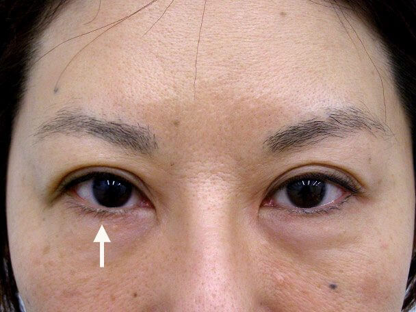 No.104 切らない眼瞼下垂(右目のみ)術後3日(メイクあり)症例写真