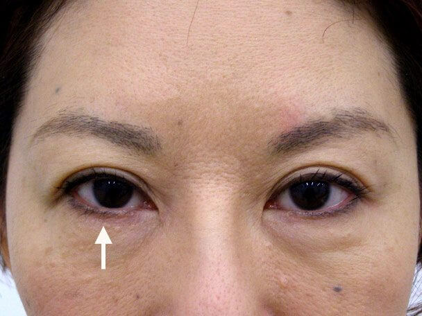 No.104 49歳 切らない眼瞼下垂(右目のみ)術後1週間(メイクあり)症例写真