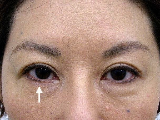 No.104 切らない眼瞼下垂 術後1ヶ月(メイクあり)症例写真