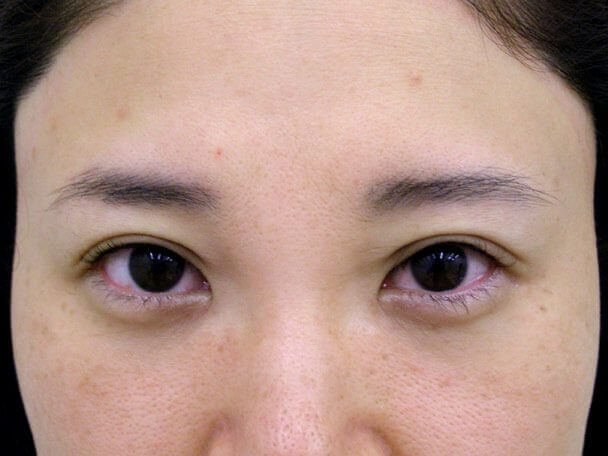 No.106 38歳 軽度切らない眼瞼下垂 術直後の症例写真