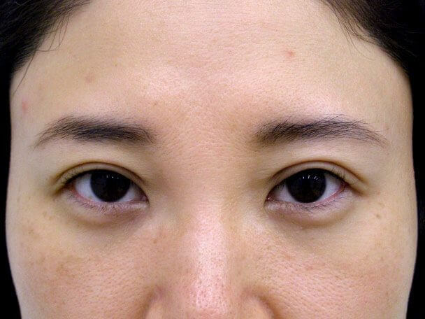 No.106 38歳 軽度切らない眼瞼下垂 術後2日の症例写真