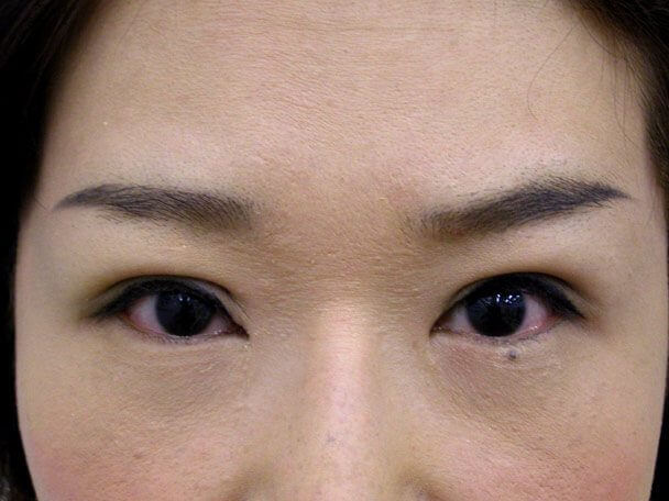 No.107 41歳 切らない眼瞼下垂 術後4日の症例写真