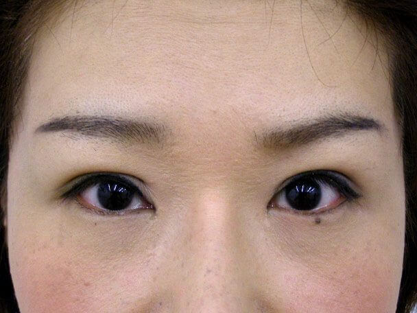 No.107 41歳 切らない眼瞼下垂 術後8日の症例写真