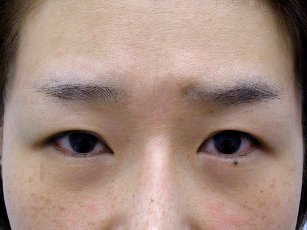 No.107 41歳 切らない眼瞼下垂 術前 症例写真