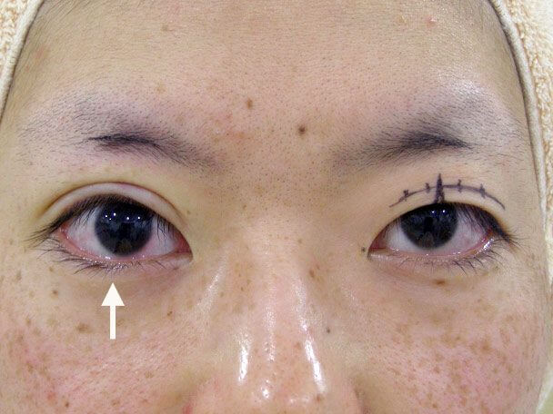 No.126 25歳 切らない眼瞼下垂 術中の症例写真