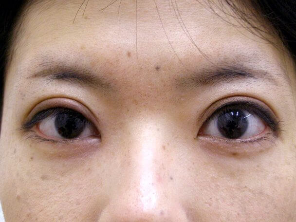 No126 25歳 真崎式二重 術後4日(メイクあり)の症例写真