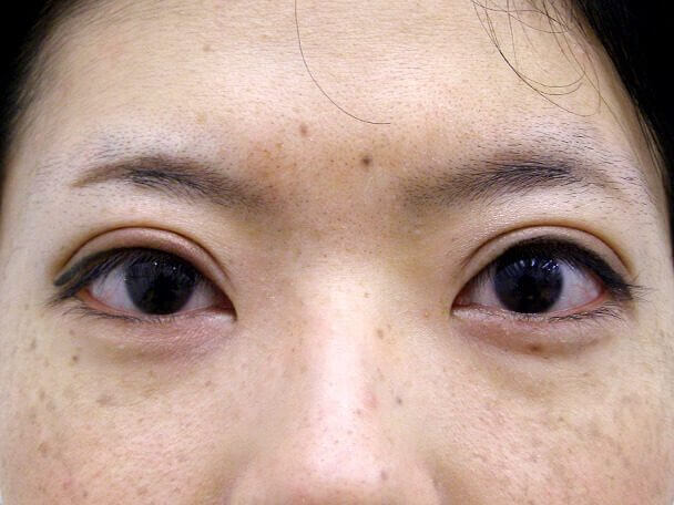 No126 25歳 真崎式二重 術後1週間(メイクあり)の症例写真