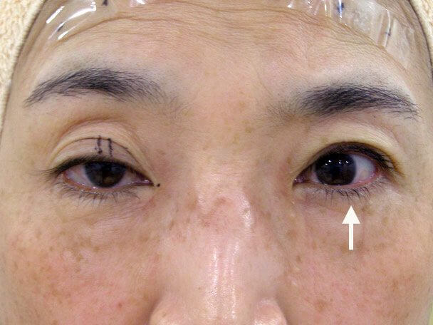 No.127 50歳切らない眼瞼下垂 術中の症例写真