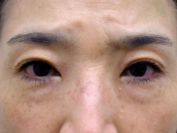 No127 50歳切らない眼瞼下垂 術後7日(メイクあり)の症例写真