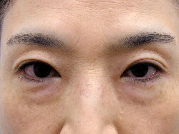 No127 50歳切らない眼瞼下垂 術後1ヶ月の症例写真