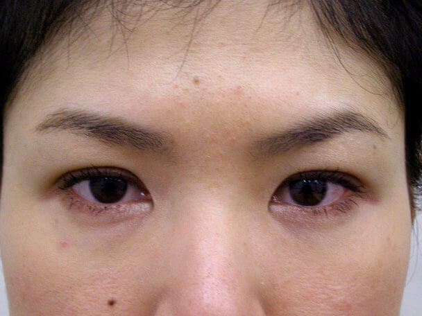 No.97 29歳二重埋没法(幅狭末広型)術後4日の症例写真