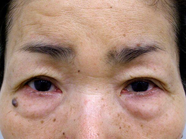 No.99 切らない眼瞼下垂(たるみたくし上げ) 術後30分の症例写真