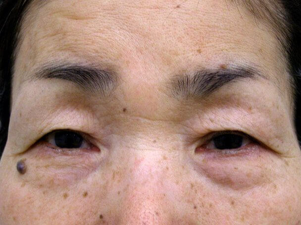 No.99 切らない眼瞼下垂(たるみたくし上げ) 術前 症例写真