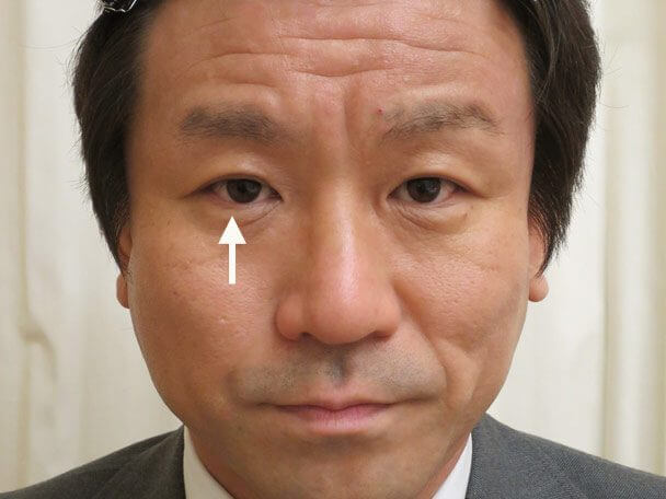 35歳男性 先天性眼瞼下垂・右目切らない眼瞼下垂 術後4年6ヶ月の症例写真