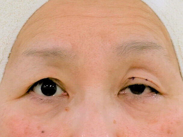 54歳重度後天性眼瞼下垂の右目術直後写真