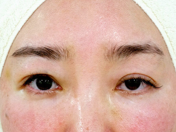 44歳中度の眼瞼下垂術中(右目だけ直後)写真