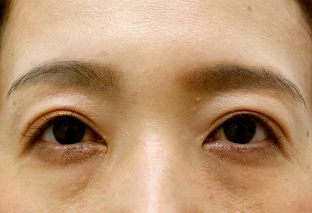 41歳 中度の後天性眼瞼下垂の術後1ヶ月後写真