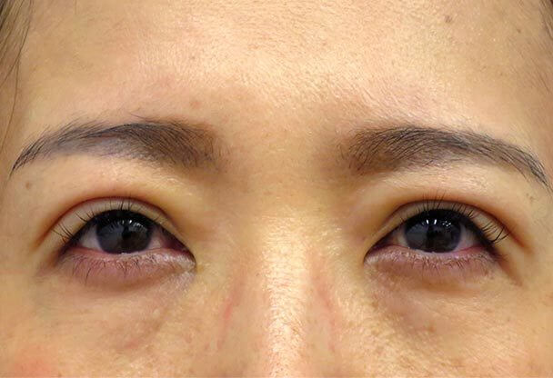 41歳 中度の後天性眼瞼下垂の術後5日後写真