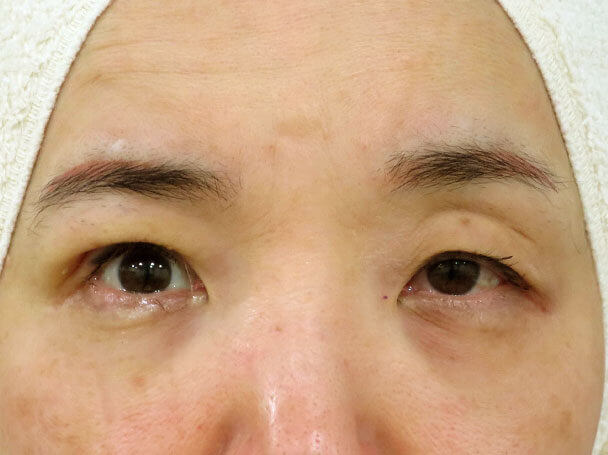 50歳中度の眼瞼下垂 術中右目のみ術直後写真