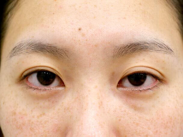 26歳 左目 中度の後天性眼瞼下垂 術前写真