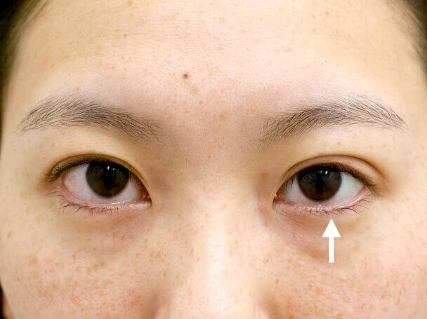 26歳 左目 中度の後天性眼瞼下垂 術直後写真