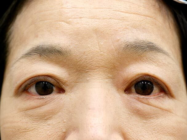 58歳 切開式眼瞼下垂術後1ヶ月(メイクあり)写真