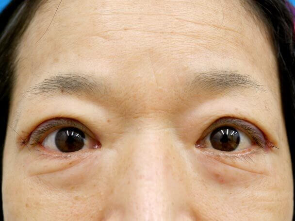 58歳 切開式眼瞼下垂術直後写真