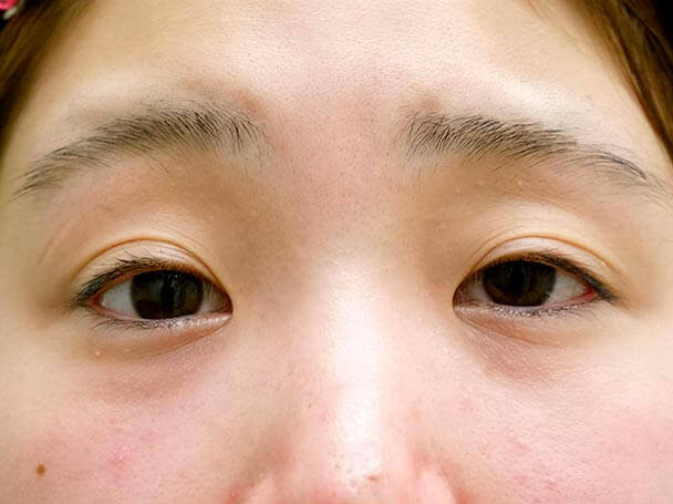 22歳 後天性眼瞼下垂 術前写真