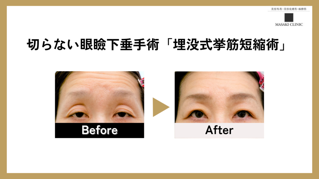 切らない眼瞼下垂（埋没式挙筋短縮術）のBefore After