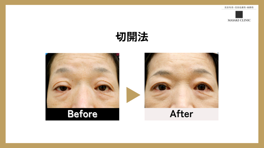 切開法のBefore After