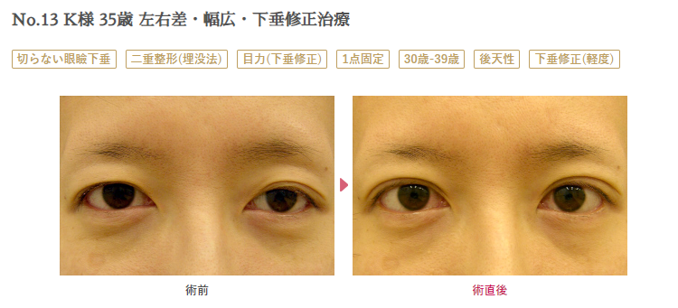 眼瞼下垂症例写真