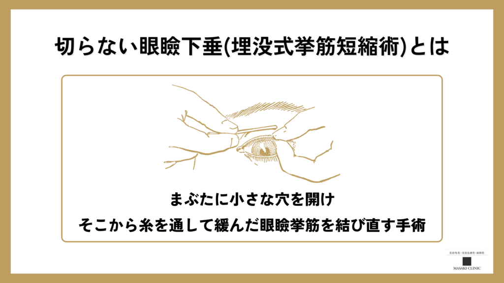 切らない眼瞼下垂手術を簡単に説明した画像